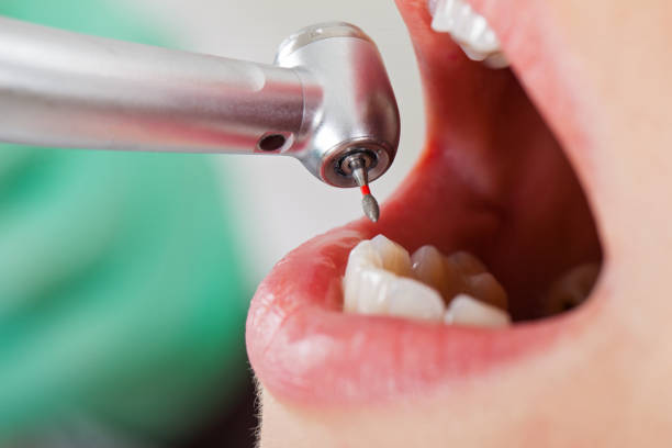 Best Emergency Wisdom Teeth Removal in Murphy, TX